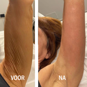 Voor en na arm