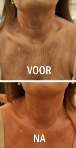 Voor en na hals