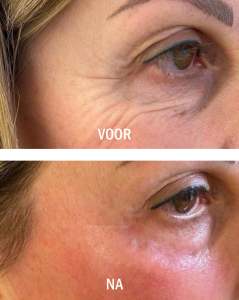 Voor en na kraaienpoten