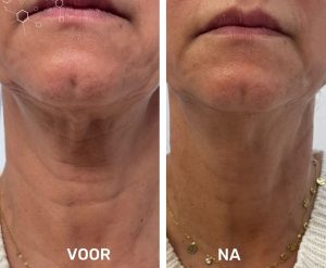 Resultaat behandeling